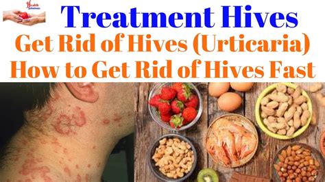 rolex hives medicine|how to treat hives quickly.